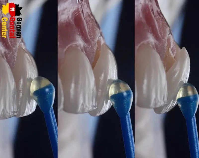 German Dental Center - Dr. Fadi Fawzy for Dental Treatment and Aesthetics