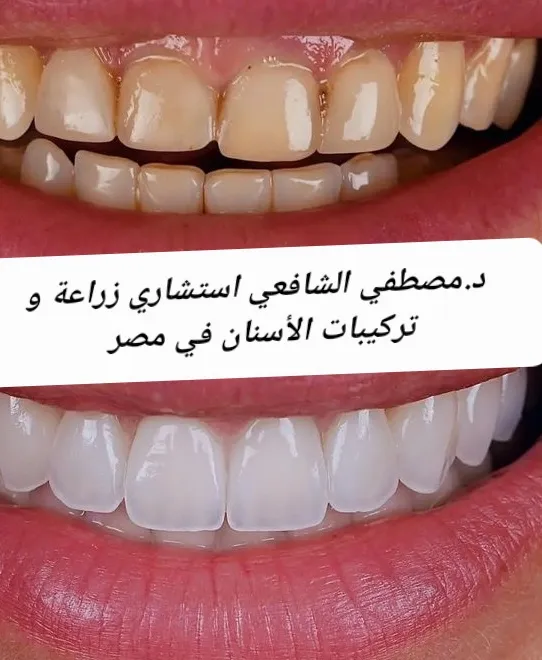 د/عمرو عبد الفتاح محمد لتقويم وزراعة الأسنان