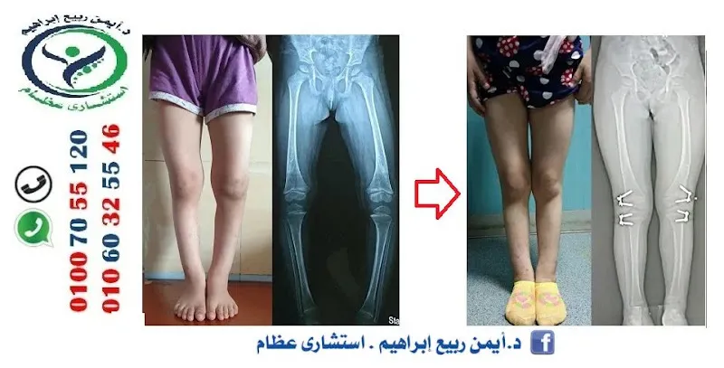 # د.ايمن ربيع ابراهيم استشاري العظام #تشوهات عظام الأطفال #كسور بالغين #كسور عظام الأطفال # تغيير مفاصل صناعية