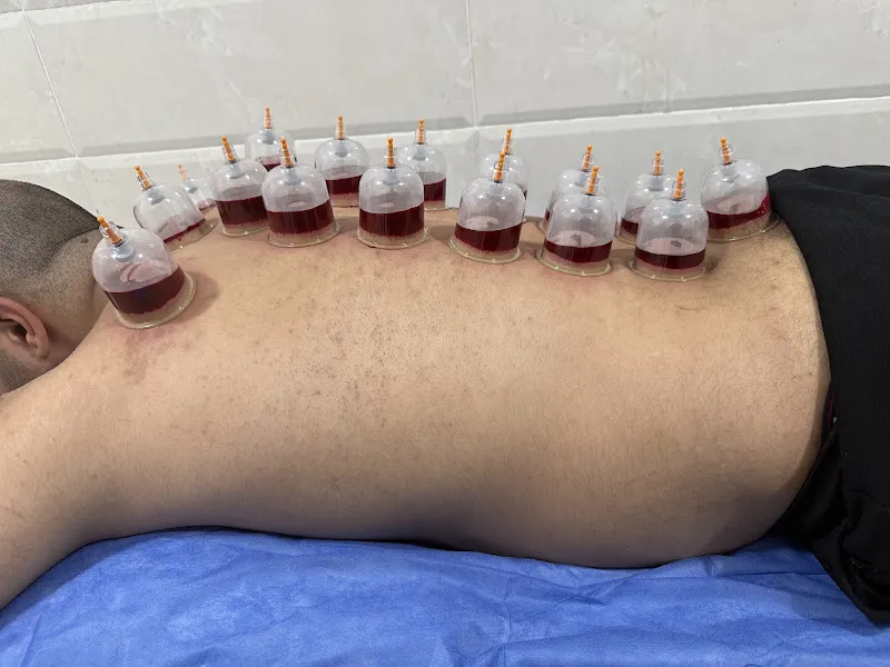 حجامة و علاج طبيعي