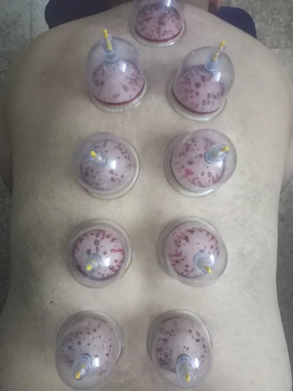 مركز دكتور يوسف غريب للحجامة