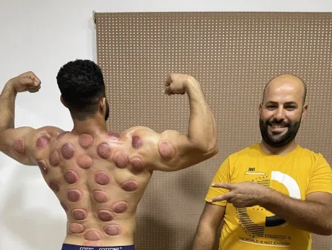 حجامة علاج
